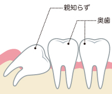 親知らずの写真(東京都文京区)